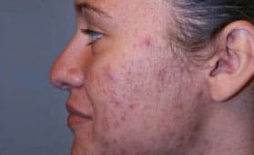 Dr. Dennis Gross Dermatology Before & After Pictures in New York, NY