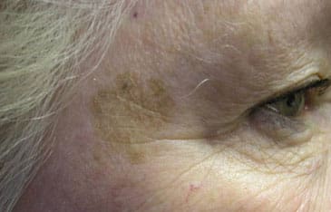 Dr. Dennis Gross Dermatology Before & After Pictures in New York, NY