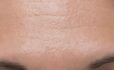 Dr. Dennis Gross Dermatology Before & After Pictures in New York, NY