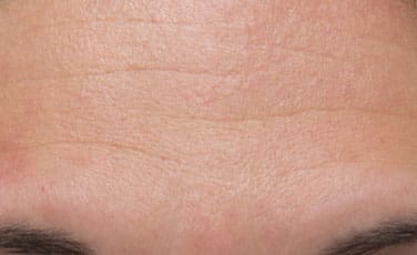 Dr. Dennis Gross Dermatology Before & After Pictures in New York, NY