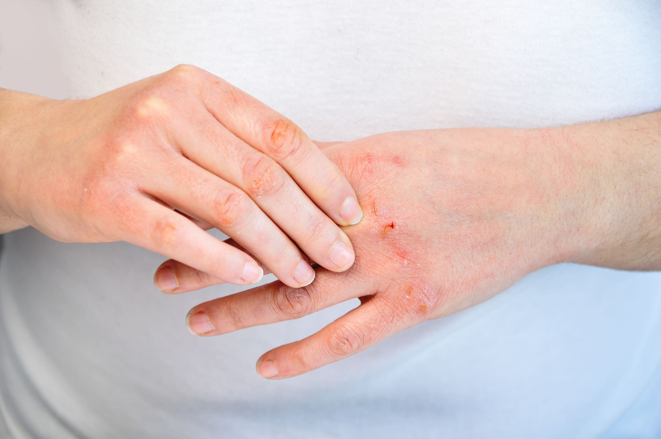 Eczema Treatment in New York, NY