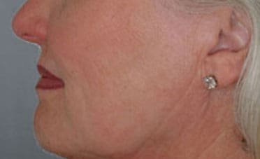 Dr. Dennis Gross Dermatology Before & After Pictures in New York, NY