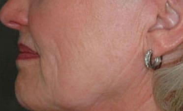 Dr. Dennis Gross Dermatology Before & After Pictures in New York, NY