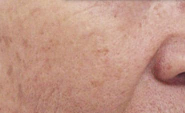 Dr. Dennis Gross Dermatology Before & After Pictures in New York, NY