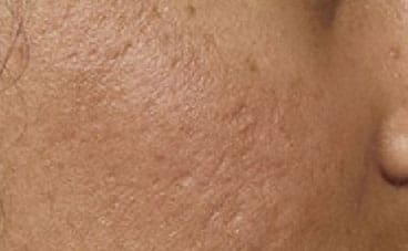 Dr. Dennis Gross Dermatology Before & After Pictures in New York, NY