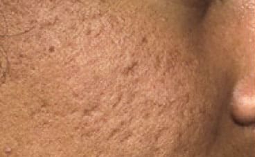 Dr. Dennis Gross Dermatology Before & After Pictures in New York, NY