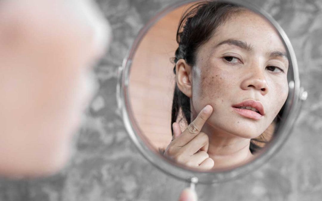 Acne Treatments in New York, NY