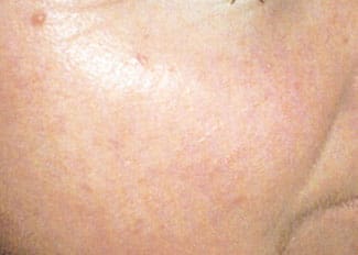 Dr. Dennis Gross Dermatology Before & After Pictures in New York, NY