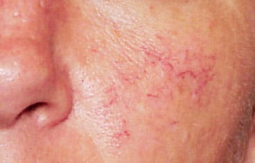 Dr. Dennis Gross Dermatology Before & After Pictures in New York, NY