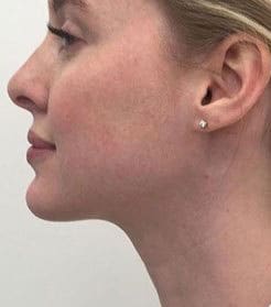 Dr. Dennis Gross Dermatology Before & After Pictures in New York, NY