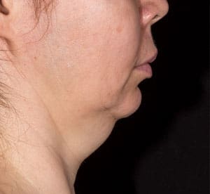 Dr. Dennis Gross Dermatology Before & After Pictures in New York, NY