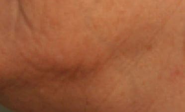 Dr. Dennis Gross Dermatology Before & After Pictures in New York, NY