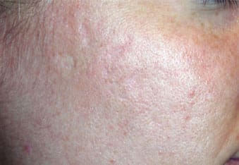 Dr. Dennis Gross Dermatology Before & After Pictures in New York, NY