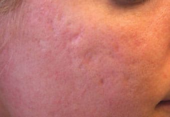 Dr. Dennis Gross Dermatology Before & After Pictures in New York, NY