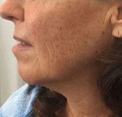 Dr. Dennis Gross Dermatology Before & After Pictures in New York, NY