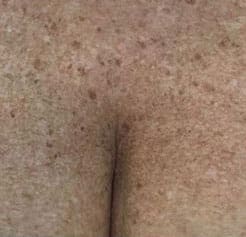 Dr. Dennis Gross Dermatology Before & After Pictures in New York, NY