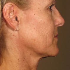 Dr. Dennis Gross Dermatology Before & After Pictures in New York, NY