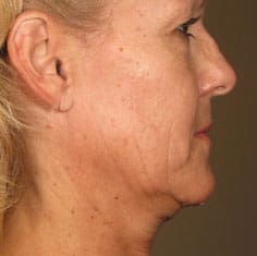 Dr. Dennis Gross Dermatology Before & After Pictures in New York, NY