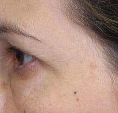 Dr. Dennis Gross Dermatology Before & After Pictures in New York, NY