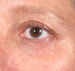 Dr. Dennis Gross Dermatology Before & After Pictures in New York, NY