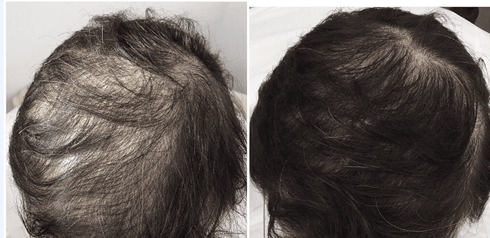 PRP for Hair Loss in New York, NY